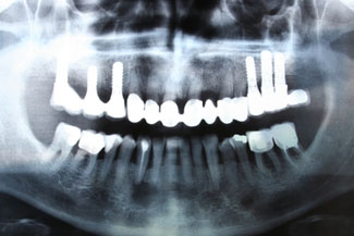 Dental Implants X-Ray